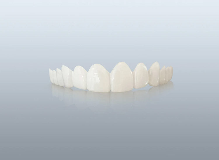 Single Arch Veneers 03 With A Smile Veneers